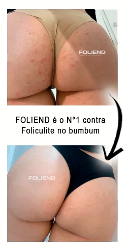 antes-e-depois-Folipro-1-1.jpg.webp