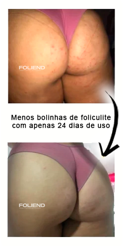 antes-e-depois-Folipro-2-2.jpg.webp
