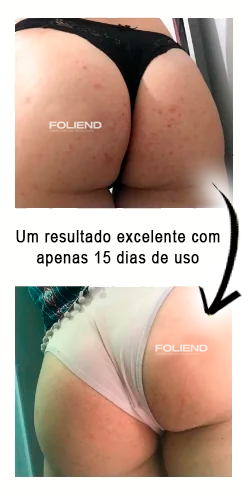 antes-e-depois-Folipro-4-1.jpg.webp