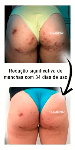 antes-e-depois-Folipro-5-1.jpg.webp
