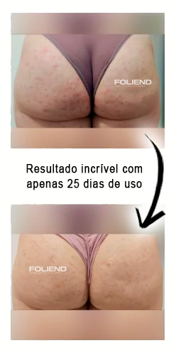 antes-e-depois-Folipro-6-1.jpg.webp